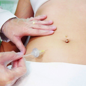 carboxiterapia