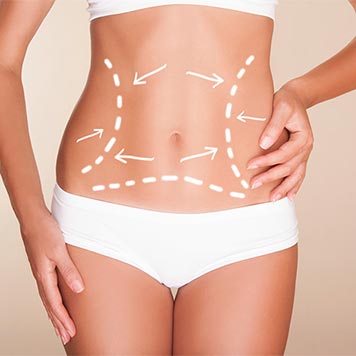 abdominoplastia